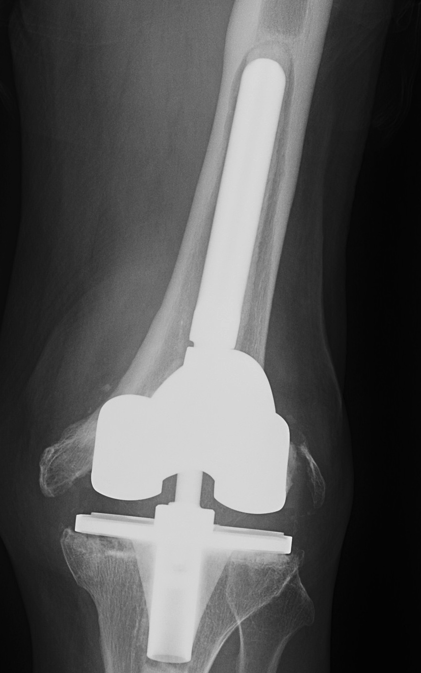 Revision TKR Deficient Metaphysis AP